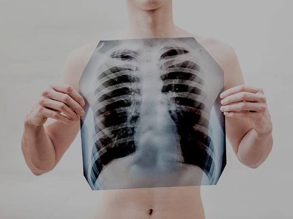 Pneumonie : provoque souvent une étanchéité/un rétrécissement du système respiratoire mécanique. 