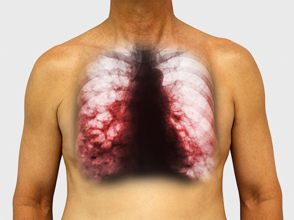Asbestosis y bronquiectasias: reduzca sus daños desarrollando su respiración 