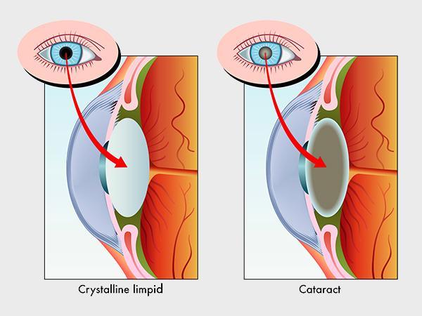 Cataracts, Operations and The Way We Breathe